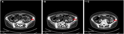 Intussusception Related to Small Intestinal Lipomas: A Case Report and Review of the Literature